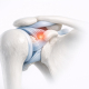 Rotator Interval Sprains: Identifying the Subtle Source of Instability or Pain