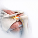 Suprascapular Nerve Entrapment: Beyond “Vague” Posterior Pain