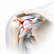 86173964-is-it-a-tear-or-a-sprain-navigating-the-shoulder-rotator-interval.png Is it a Tear or a Sprain? Navigating the Shoulder Rotator Interval
